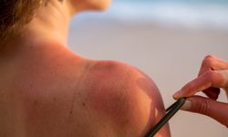 Bronzlaşma Nedir? Sağlıklı Bronzlaşma İçin Uzman Önerileri