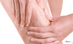 Prof. Dr. Karacalar: Selülit Estetik Değil Metabolik Sorun