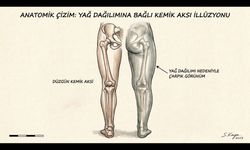 Çarpık Bacaklara Kemik Kırmadan Estetik Çözüm