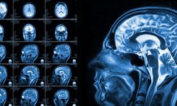 Beyin MR’ında Görülen Lekeler Tehlikeli mi? Uzmanından Kritik Uyarılar