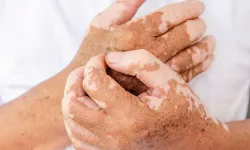 Vitiligo Nedir? Belirtileri, Nedenleri ve Güncel Tedavi Yöntemleri