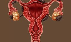 Çikolata Kisti Hamile Kalmayı Zorlaştırabilir, Uzmanından Endometriozis Uyarısı
