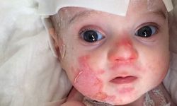 Çocuklarda Bu Belirtilere Dikkat! Lupus Hastalığı Organları Etkileyebilir