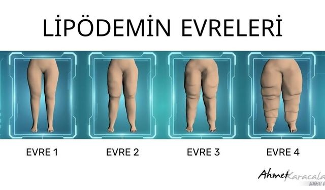 Prof. Karacalar: “Bu Bir Obezite Değil, Evrimsel Miras”