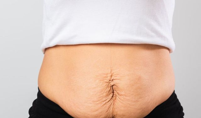 Doğum Sonrası Karın Şişliğine İzsiz Endoskopik Çözüm