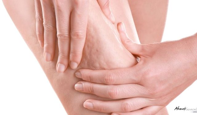 Prof. Dr. Karacalar: Selülit Estetik Değil Metabolik Sorun