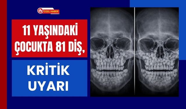 11 Yaşındaki Çocukta 81 Diş, Kritik Uyarı