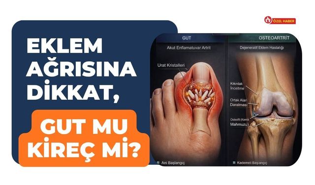 Eklem Ağrısına Dikkat, Gut Mu Kireç Mi?