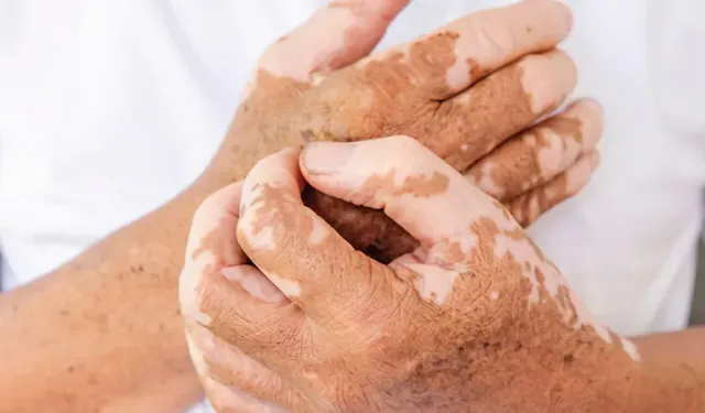 Vitiligo Nedir? Belirtileri, Nedenleri ve Güncel Tedavi Yöntemleri