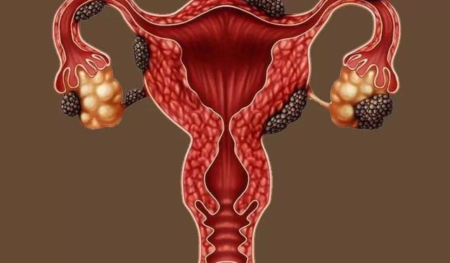 Çikolata Kisti Hamile Kalmayı Zorlaştırabilir, Uzmanından Endometriozis Uyarısı