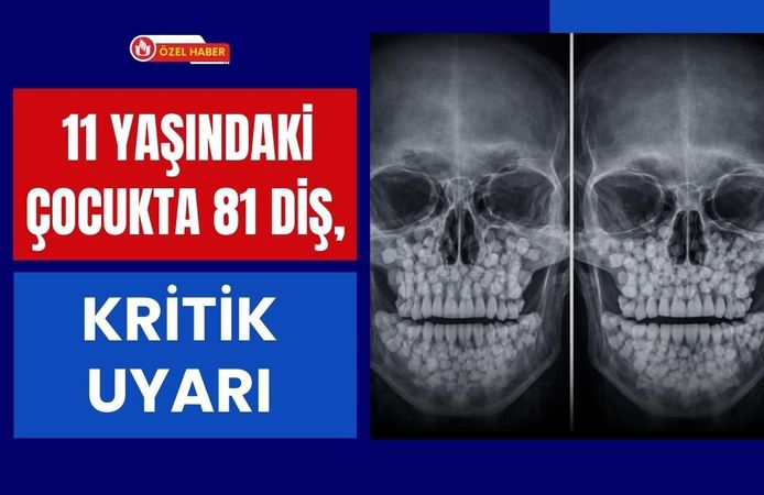 11 Yaşındaki Çocukta 81 Diş, Kritik Uyarı