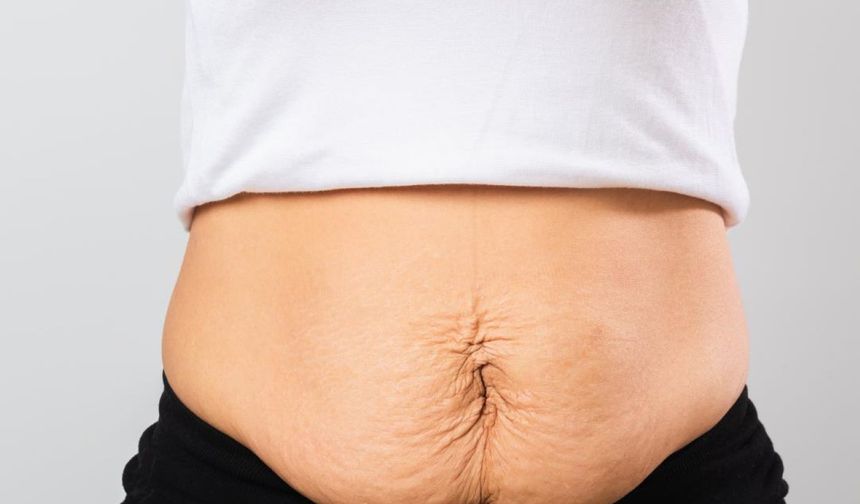 Doğum Sonrası Karın Şişliğine İzsiz Endoskopik Çözüm