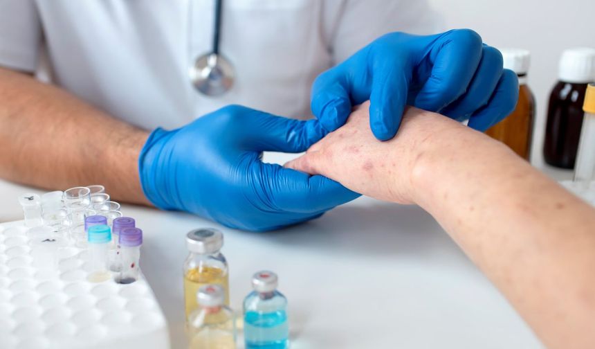 50 Yaş Üstüne Uyarı, Zona Virüsü Yıllar Sonra Uyanabilir