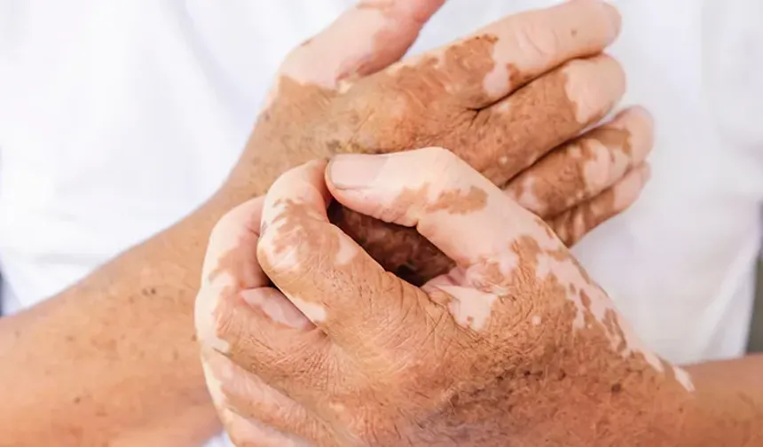 Vitiligo Nedir? Belirtileri, Nedenleri ve Güncel Tedavi Yöntemleri