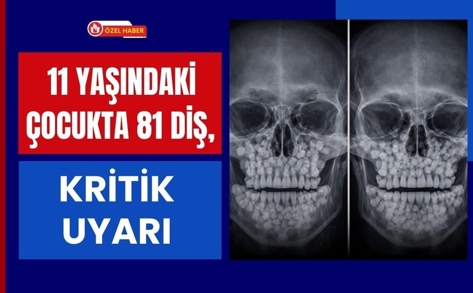 11 Yaşındaki Çocukta 81 Diş, Kritik Uyarı