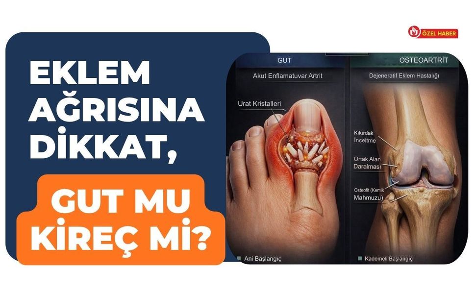 Eklem Ağrısına Dikkat, Gut Mu Kireç Mi?