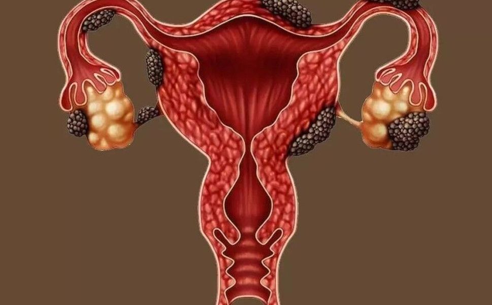Çikolata Kisti Hamile Kalmayı Zorlaştırabilir, Uzmanından Endometriozis Uyarısı