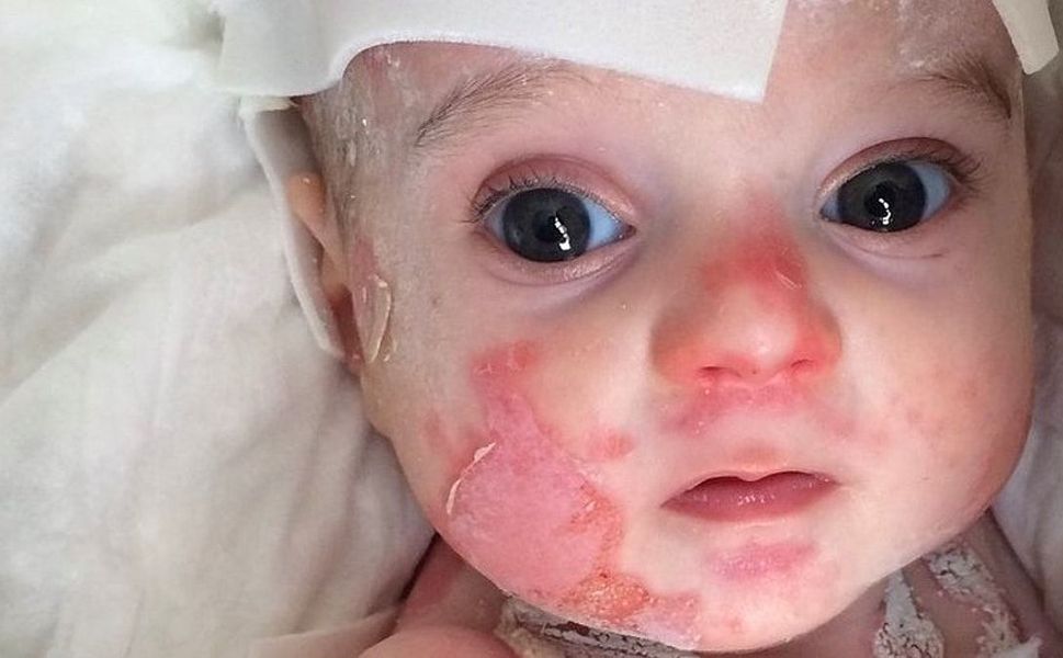Çocuklarda Bu Belirtilere Dikkat! Lupus Hastalığı Organları Etkileyebilir