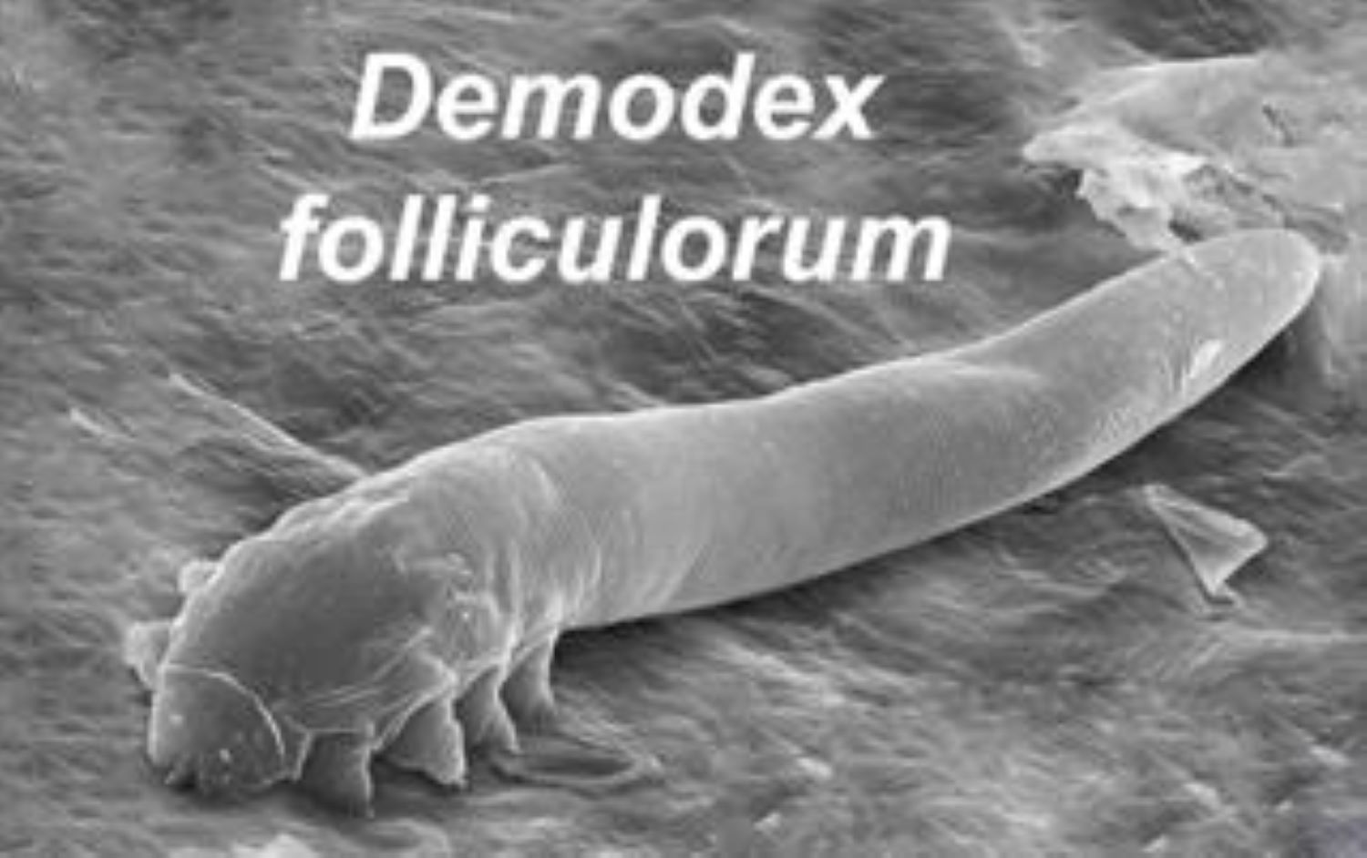 Demodex Folliculorum 193115173