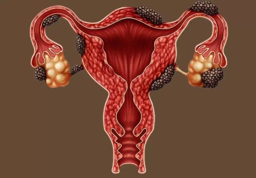 Çikolata Kisti Hamile Kalmayı Zorlaştırabilir, Uzmanından Endometriozis Uyarısı